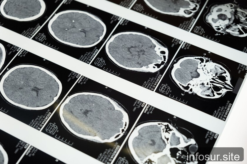 Mala salud metabólica envejece el cerebro sin importar la edad